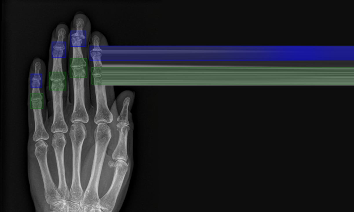Detect, Score, Explain: Anatomy of an ML Pipeline for Hand X-Rays